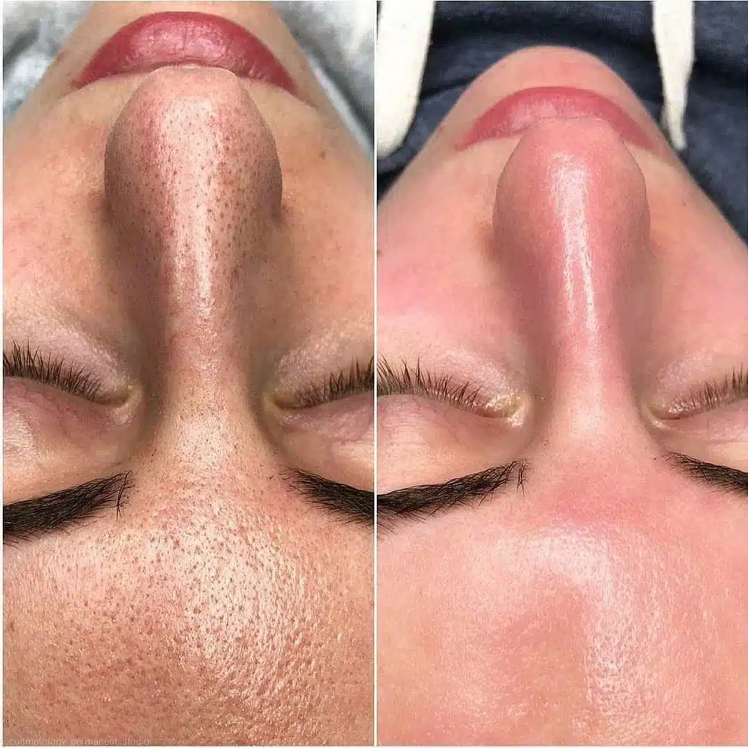 Deep cleansing facial in Los Angeles at EstheticsLA