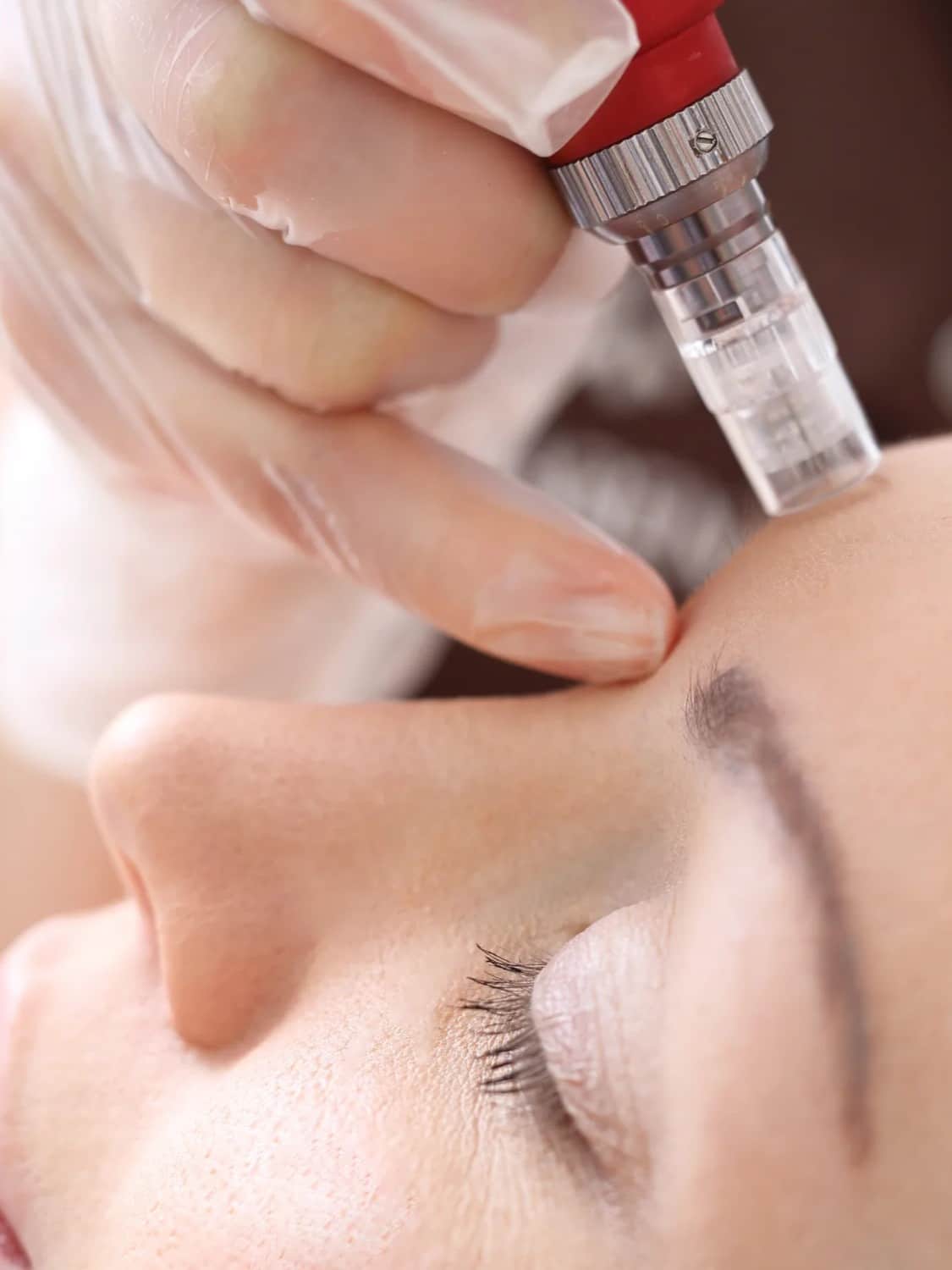 Microchanneling facial treatment in Los Angeles